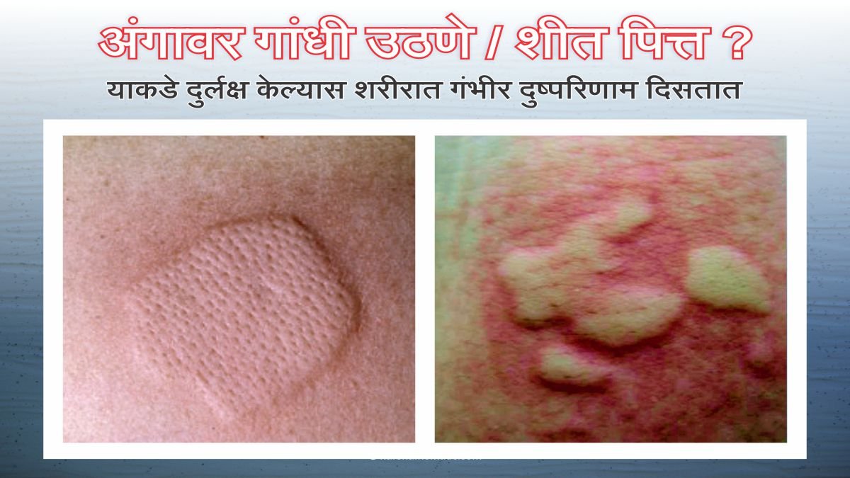 urticaria पित्त उठणे शितपित्त