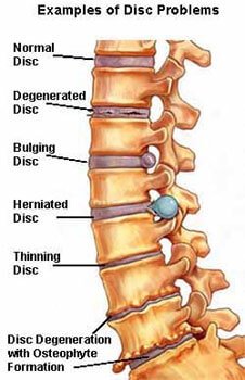 ayurvedic treatment for spinal cord injury