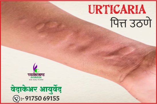 शितपित्त-pitt-uthane-urticaria-ayurvedic-treatment