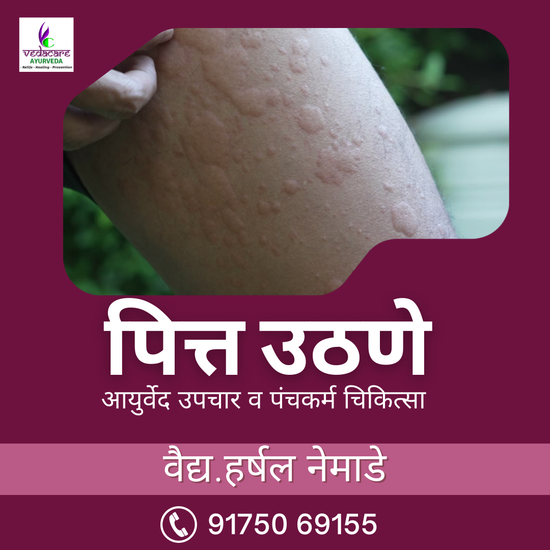 urticaria hives shitpitta pitti khaj yene treatment upay upachar